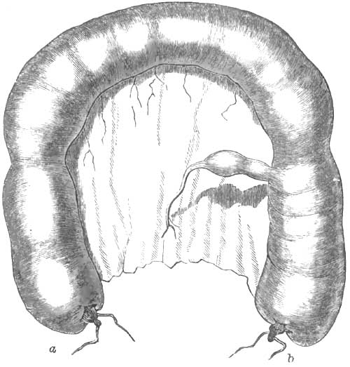 Natural relations of the diverticulum to the intestine