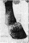 A CASE OF BUTTRESS FOOT.