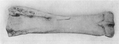 Fig. 16—Posterior view of radius (right) illustrative of effects of splint. Note the extent of exostosis. Fig. 16—Posterior view of radius (right) illustrative of effects of splint. Note the extent of exostosis.