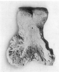 Fig. 30—Rarefying osteitis wherein articular cartilage was destroyed in a case of arthritis of fetlock joint. Fig. 30—Rarefying osteitis wherein articular cartilage was destroyed in a case of arthritis of fetlock joint.