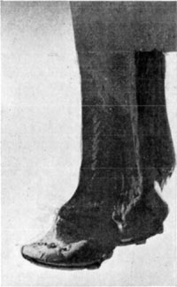 Fig. 33—The hoof in chronic laminitis. Note the concavity. This animal was serviceable for any work that could be performed at a walk. Fig. 33—The hoof in chronic laminitis. Note the concavity. This animal was serviceable for any work that could be performed at a walk.