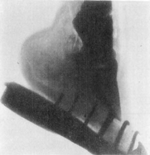 Fig. 39—Skiagraph of foot. The X-ray offers very limited possibilities in the diagnosis of lameness. The location of a ''gravel'' or a nail that had worked its way some distance from the surface, or of an abscess of some proportion, deep in the tissues, might be facilitated under some circumstances by the aid of the X-ray. Its use in the detention of fractures is very limited, owing to the difficulty encountered in getting a view from the right position—many trials being necessary in most cases. The case shown above was diagnosed clinically as incipient ringbone. The X-ray revealed no lesions. (Photo by L. Griessmann.) Fig. 39—Skiagraph of foot. The X-ray offers very limited possibilities in the diagnosis of lameness. The location of a ''gravel'' or a nail that had worked its way some distance from the surface, or of an abscess of some proportion, deep in the tissues, might be facilitated under some circumstances by the aid of the X-ray. Its use in the detention of fractures is very limited, owing to the difficulty encountered in getting a view from the right position—many trials being necessary in most cases. The case shown above was diagnosed clinically as incipient ringbone. The X-ray revealed no lesions. (Photo by L. Griessmann.)