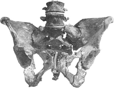 Fig. 55.—Multiple Fracture of Pelvis through Horizontal and Descending Rami of both Pubes, and Longitudinal Fracture of left side of Sacrum.