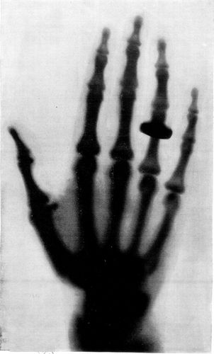PHOTOGRAPH OF A LADY'S HAND SHOWING THE BONES, AND A RING ON THE THIRD FINGER, WITH FAINT OUTLINES OF THE FLESH.
