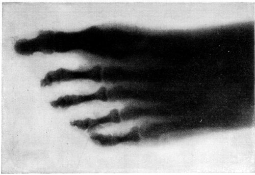 BONES OF A HUMAN FOOT PHOTOGRAPHED THROUGH THE FLESH.