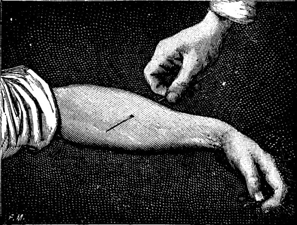 ARM PIERCED BY NEEDLE FIG. 4.—AN ARM TRANSPIERCED BY A NEEDLE.