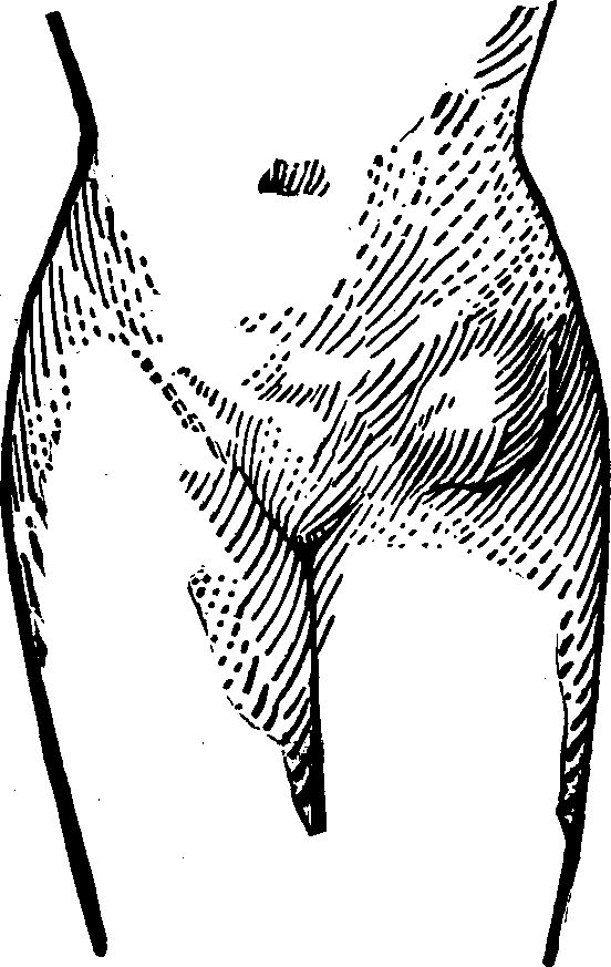 Illustration: Fig. 2. This figure illustrates a case of Femoral Hernia