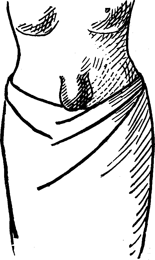Illustration: Fig. 3. UMBILICAL HERNIA.