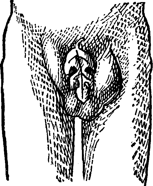 Illustration: Fig. 5. This figure illustrates a Double Inguinal Hernia