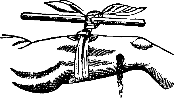 Illustration: Fig. 1. The field Tourniquet as applied.