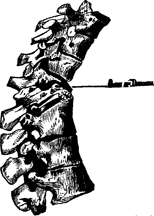 Illustration: Fig. 1. The above portion of the spinal column shows the manner of the breaking down of the vertebræ from caries, and the absorption of their bony structure.