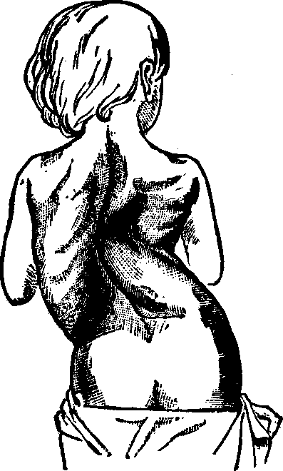 Illustration: Fig. 9. Lateral curvature in an advanced stage.